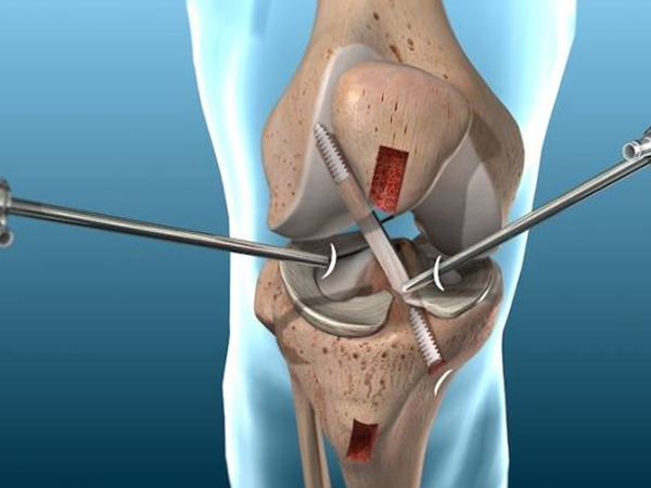 Arthroscopy (Knee, Shoulder, Hip)