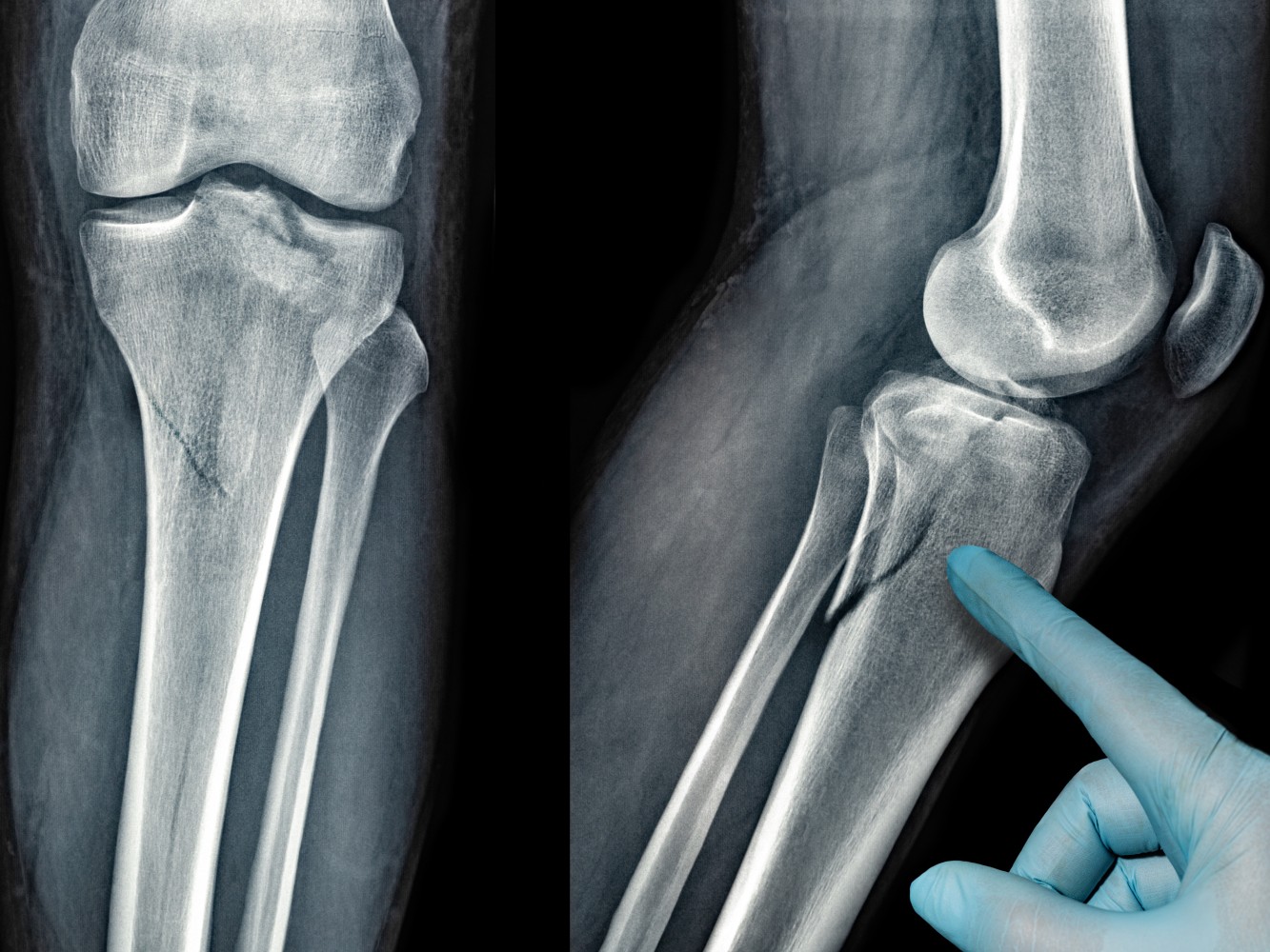 Complex Fracture Treatment